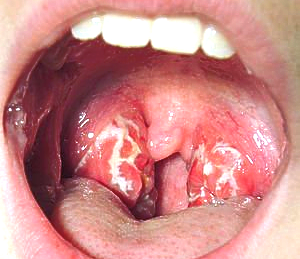 Faringite estreptocócica